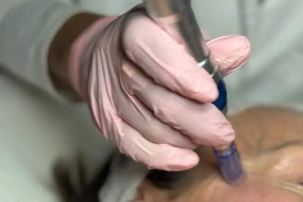 Dermapen con exosomas en Valencia aplicado en tratamiento facial regenerativo